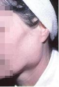 Dr. Szalmay - fül-orr-gégész szakorvos - Nyaki műtétek -  - 10_parotid gland.jpg