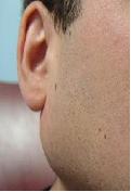 Dr. Szalmay - fül-orr-gégész szakorvos - Nyaki műtétek -  - 10_parotid gland.jpg