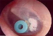 Dr. Szalmay - fül-orr-gégész szakorvos - Szellőző tubus (grommet) behelyezése