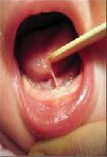 Dr. Szalmay - fül-orr-gégész szakorvos - Nyelvfék oldás (lenőtt nyelv oldása, frenulotomia)